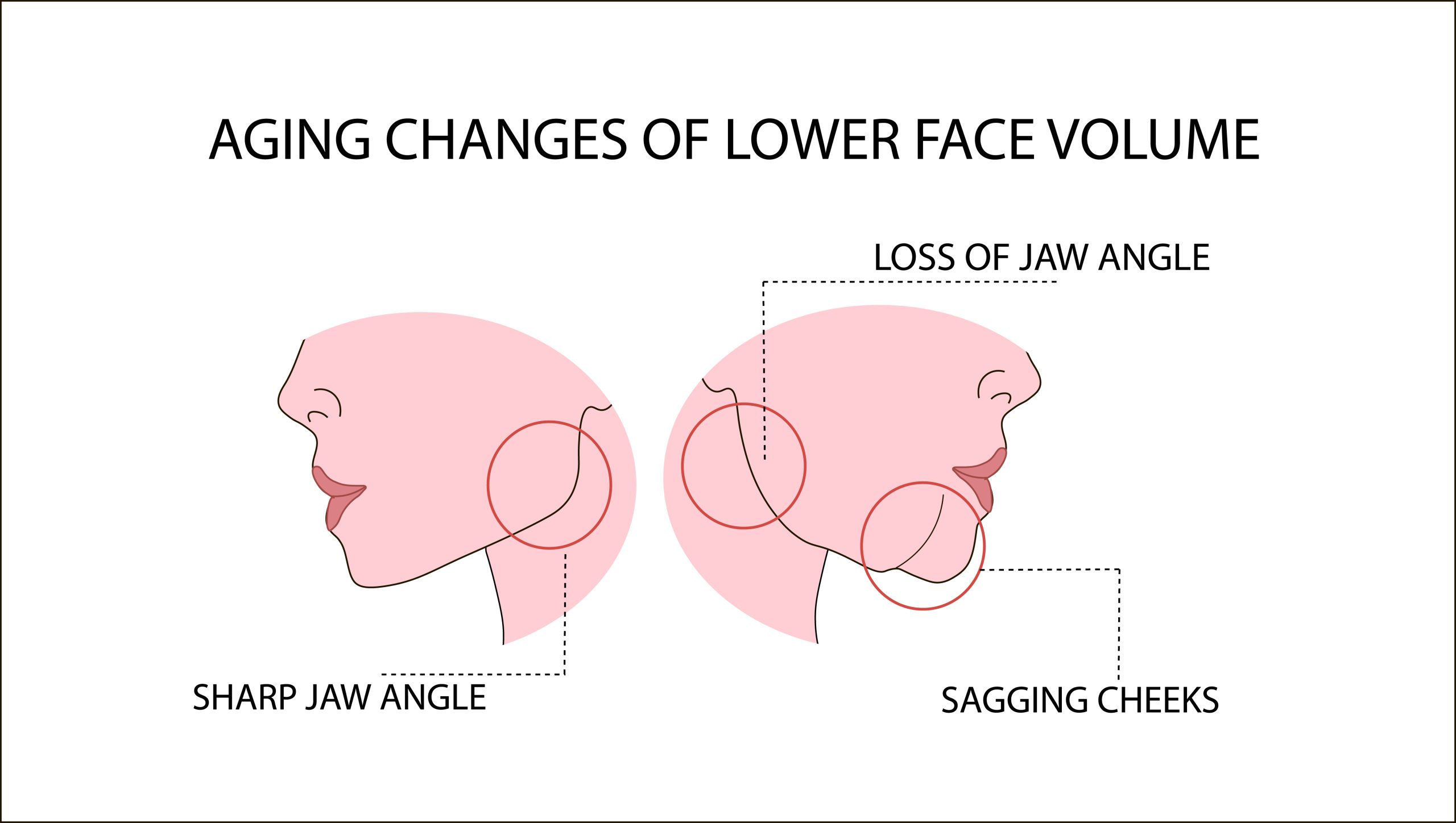 Aging,Changes,Of,Lower,Face,Volume